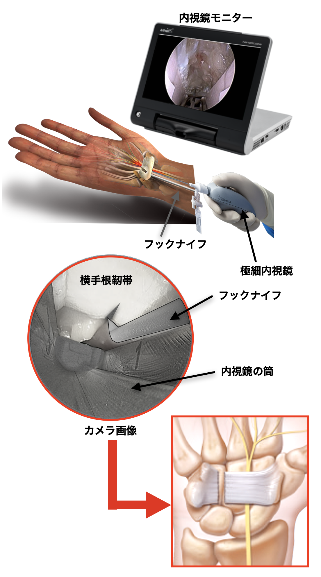 Ectr Layout 内視鏡下開放術ECTR | 丸亀整形外科とだにクリニック