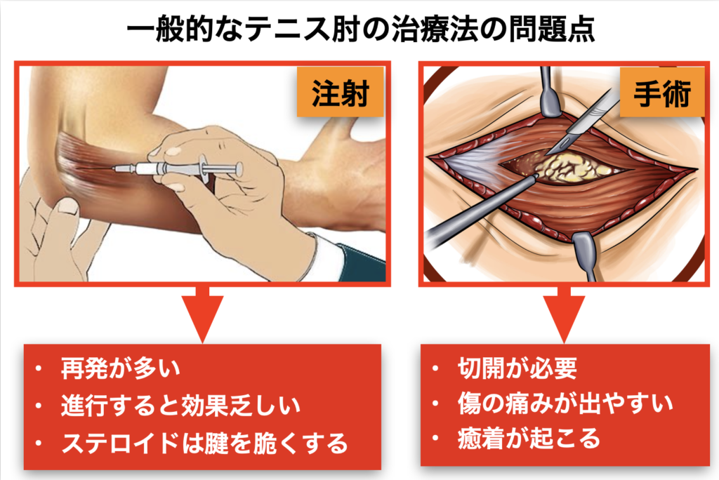 テニス肘の手術とは何ですか?